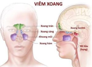 nguyen nhan nao gay ra benh viem xoang