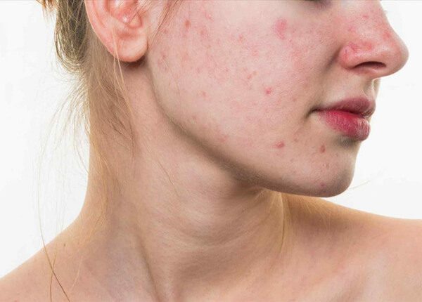 Nguyên nhân triệu chứng và phòng chống sốt phát ban