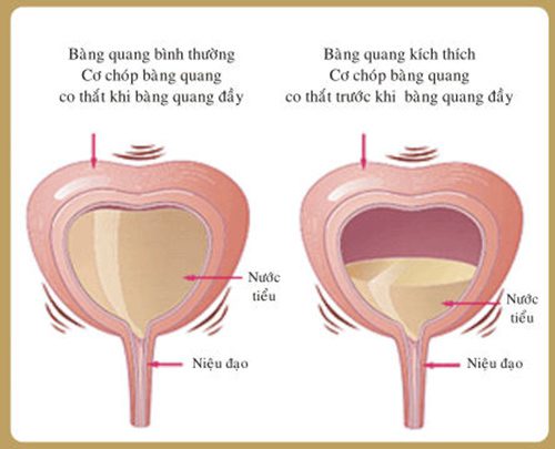 viem bang quang cap tinh 1
