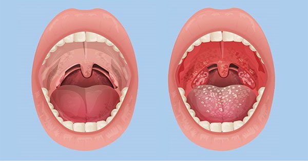 Sự khác biệt giữa người khỏe mạnh và người bị viêm họng