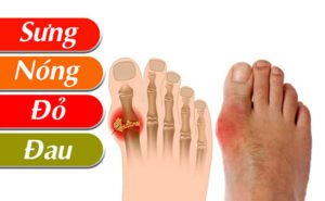 Biểu hiện điển hình của bệnh Gout