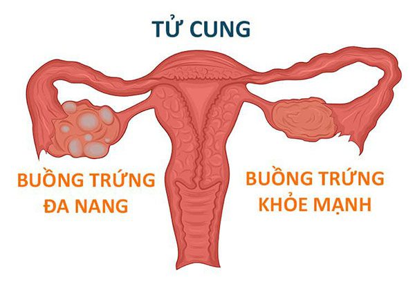 Biểu hiện của bệnh buồng trứng đa nang