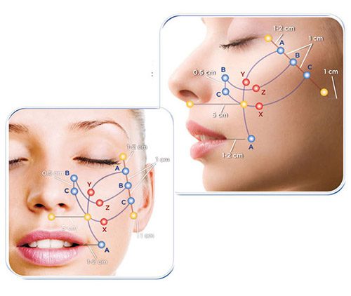 Căng da mặt bằng chỉ đang được nhiều chị em ưa thích