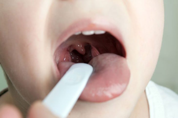 Viêm Amidan ở trẻ em: Triệu chứng, điều trị và cách phòng ngừa