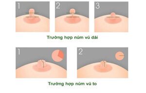 Thu nhỏ nhũ hoa bằng phẫu thuật là hiệu quả nhất
