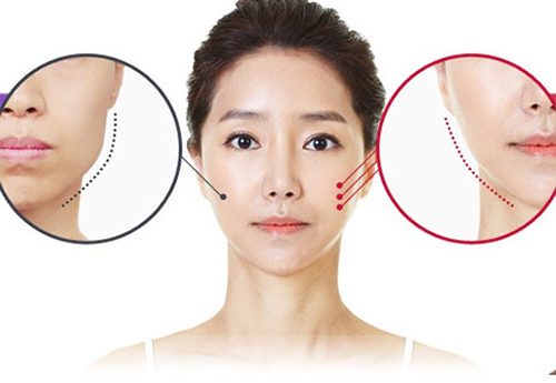 Độn cằm không phẫu thuật không cần dao kéo