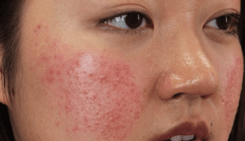 Việc điều trị da nhiễm Corticoid sẽ trở lên rất khó khăn và tốn kém chi phí