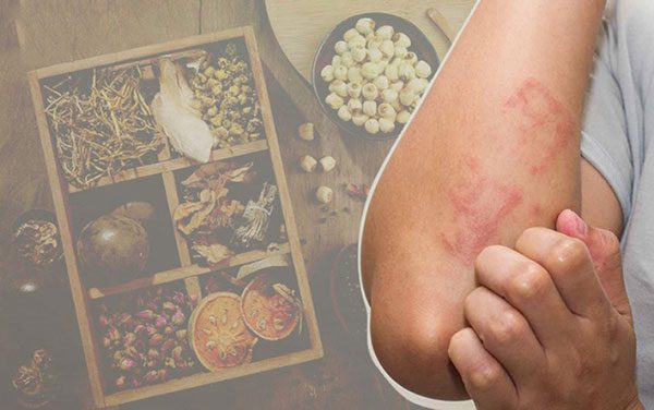 Trị chứng ngứa về đêm bằng bài thuốc YHCT
