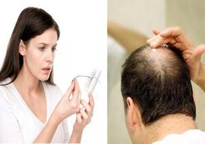 Rụng tóc – Nỗi ám ảnh không của riêng ai