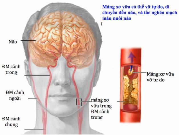 thiếu máu lên não