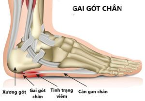 Bệnh gai gót chân chữa trị như thế nào?