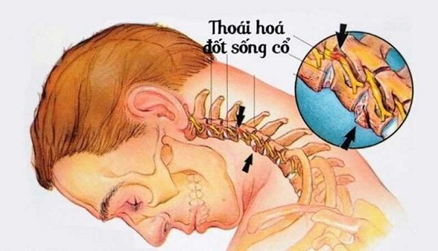 trieu chung benh thoai hoa dot song co 1 1