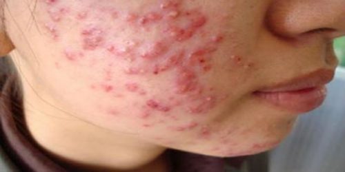 Những người sử dụng mỹ phẩm chứa Corticoid da thường bị ban đỏ và nổi nhiều mụn