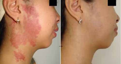Điều trị bớt chàm đỏ rất hiệu quả