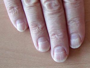 Nên cảnh giác khi có đốm trắng trên móng tay, móng chân