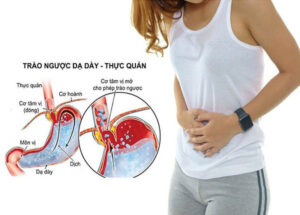 Benh trao nguoc da day co nguy hiem khong