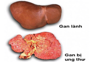 CC3B3 nhiE1BB81u ngC6B0E1BB9Di C491ang sai lE1BAA7m trong chuyE1BB87n chE1BBAFa bE1BB87nh ung thC6B0 gan1