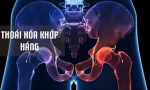 ChuyC3AAn gia cE1BAA3nh bC3A1o nhE1BBAFng tC3ACnh trE1BAA1ng thoC3A1i hC3B3a khE1BB9Bp hC3A1ng