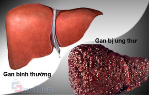 ai de mac ung thu gan nhu cuu tong thong my jimmy carter hinh 3