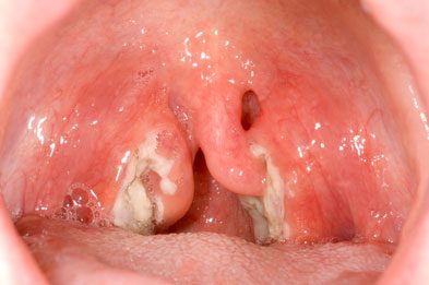 Điều trị bệnh ung thư amidan bằng bài thuốc cổ truyền