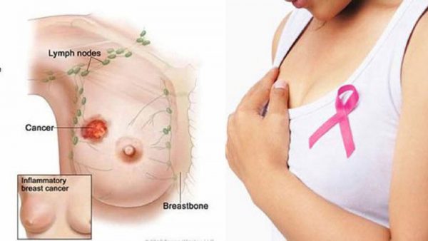 Bệnh áp-xe tuyến vú là tình trạng tuyến vú bị tắc nghẽn, sữa ứ đọng