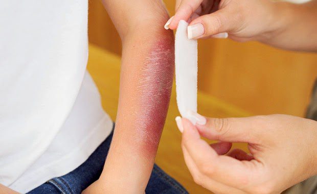 Bị bỏng do nhiều nguyên nhân khác nhau