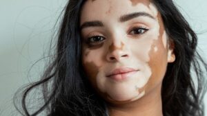 benh bach bien nguyen nhan dau hieu nhan biet va cach dieu tri 9 800x450 1 1