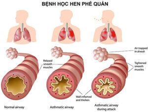 benh hen phe quan 1