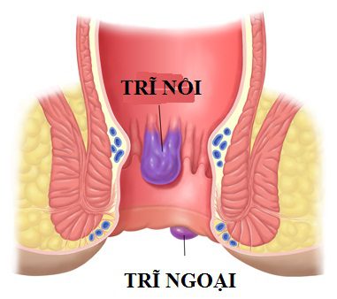 benh-tri-ngoai