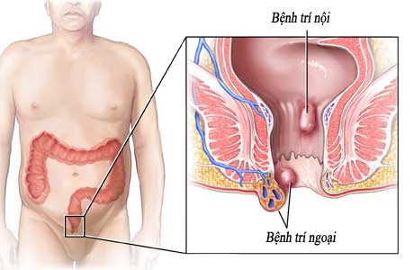 benh-tri-ngoai