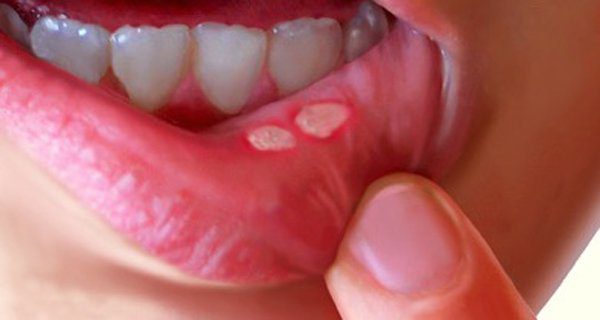 Ung thư miệng với những dấu hiệu thường gặp ít ai ngờ tới