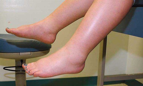 Cảnh báo xoa bóp trị bong gân làm bệnh nặng thêm nặng