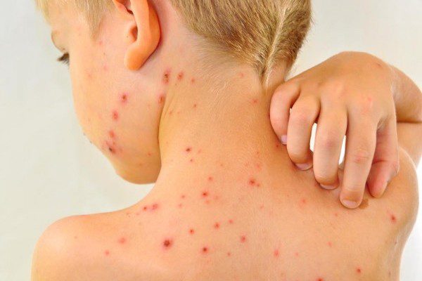 chicken pox 600x400 6