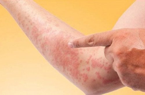 Điều trị và khắc phục các phản ứng dị ứng do vật nuôi gây ra