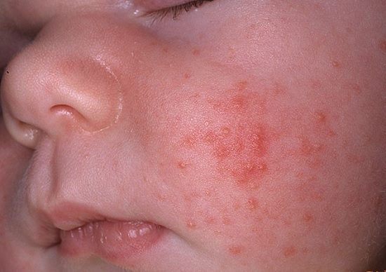 Nguyên lý trong điều trị nổi mề đay, mẩn ngứa