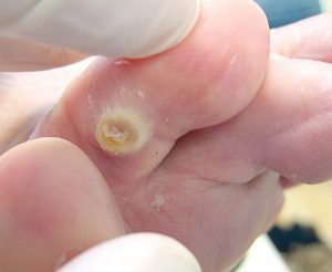 Một số dạng mụn cóc thường gặp hiện nay
