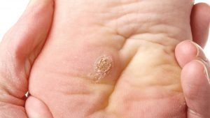 Làm sao để trị dứt điểm mụn cóc ?