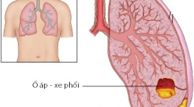 ap-xe-phoi