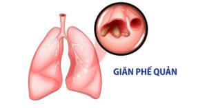 gian phe quan 1