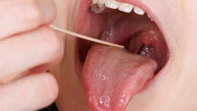 huong dan phan biet nhiet mieng va ung thu luoi 614fdce93c