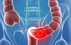 meo chua benh viem dai trang bang bai thuoc dan gian 1