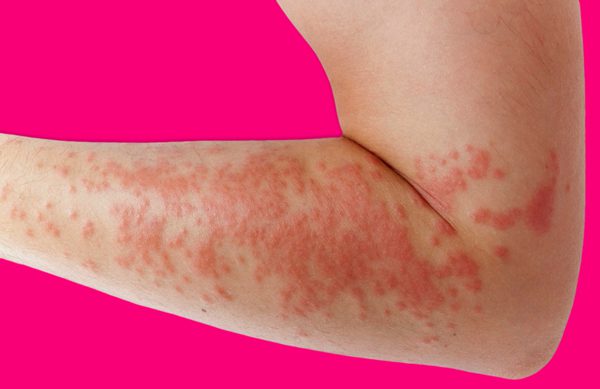 Triệu trứng và các dạng của nổi mề đay