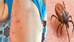 sot mo o tre em trieu chung cach dieu tri va cac bien phap phong benh 1 1721180215132914906057