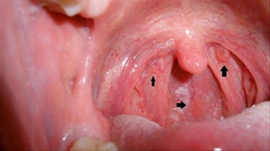 Các tri giác bị hạn chế giảm khả năng vận động của lưỡi