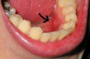 Những dấu hiệu của bệnh ung thư khoang miệng