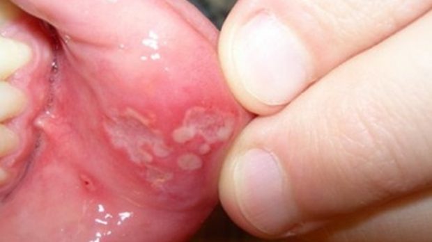 Khu vực khoang miệng có cảm giác đau đớn