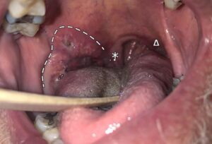 Ung thư amidan và biện pháp phòng tránh bạn cần biết!