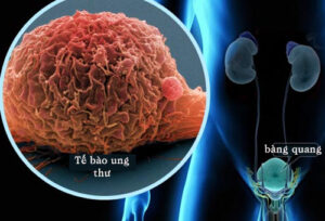 ung thu bang quang 1
