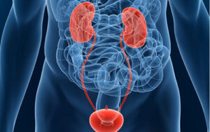 ung thu bang quang 2