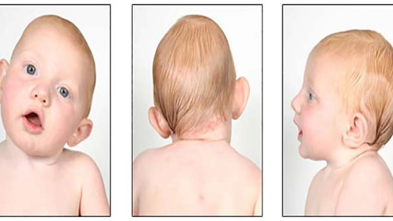 Vẹo cổ trong y học cổ truyền còn được gọi là lạc phẩm hay thất phẩm